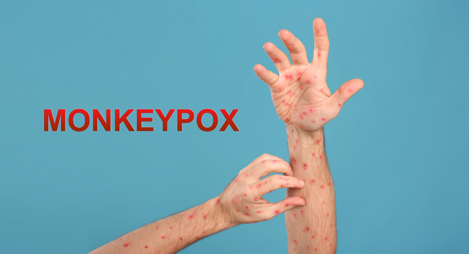 Cacar Monyet (Monkeypox)