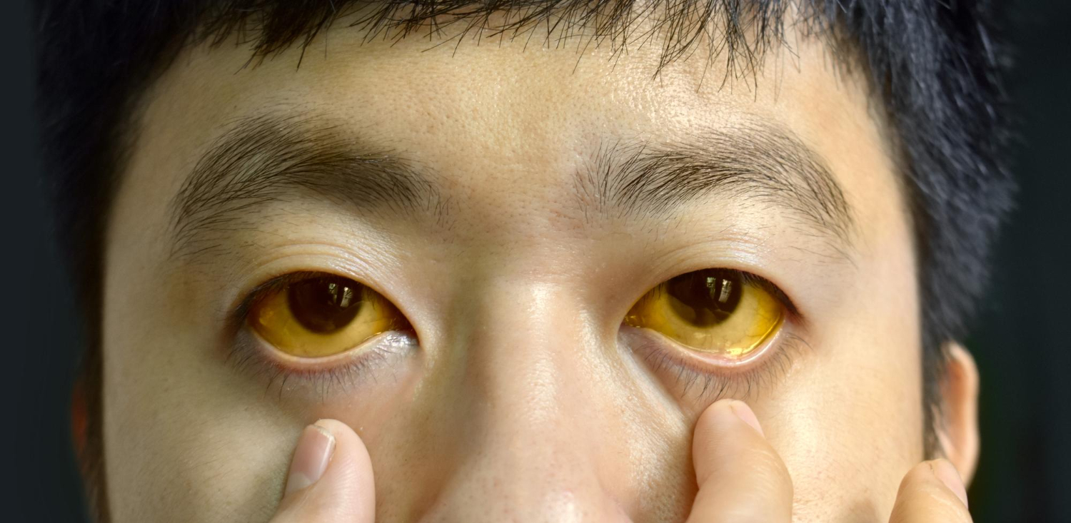 Jaundice (Penyakit Kuning)