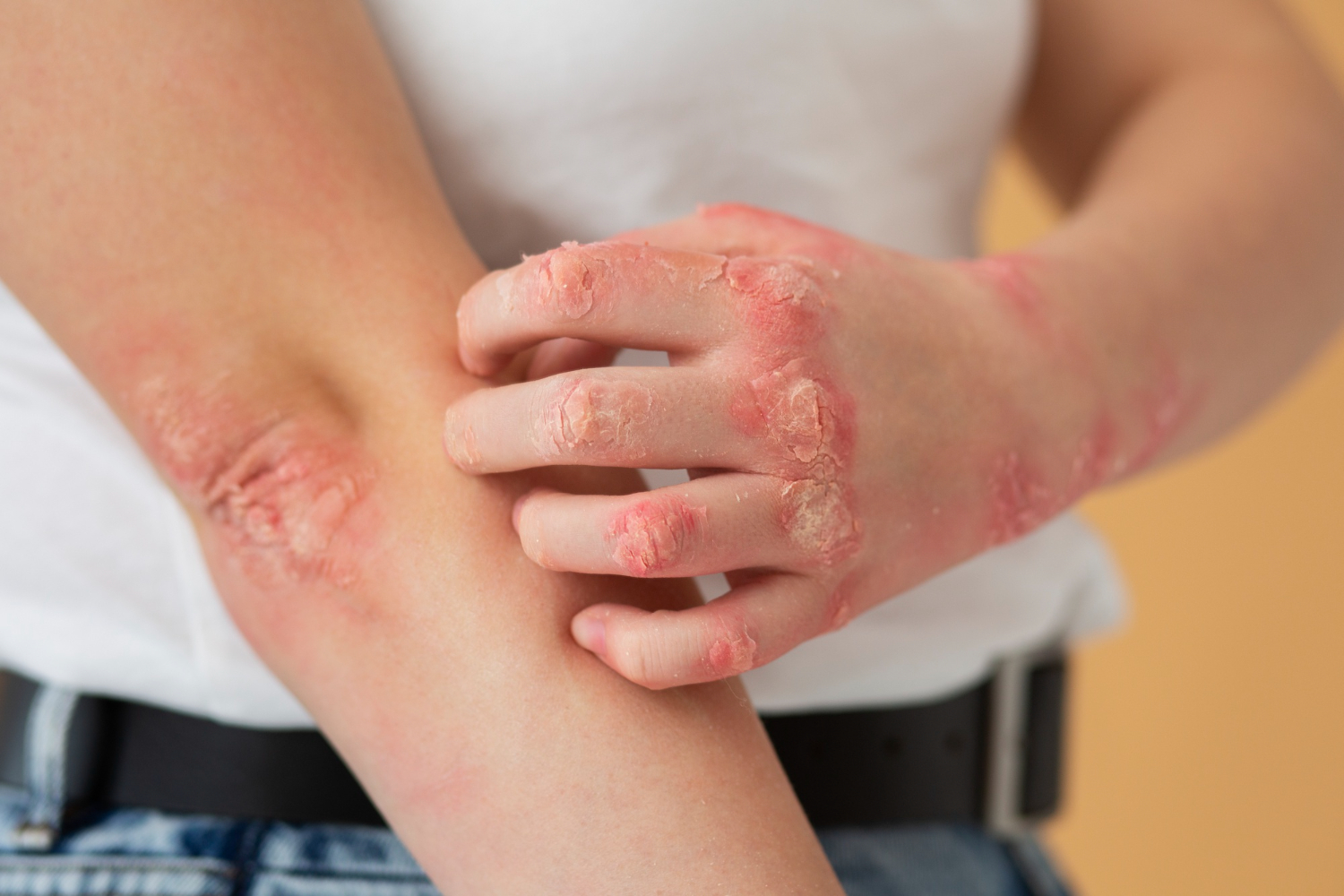 Psoriasis