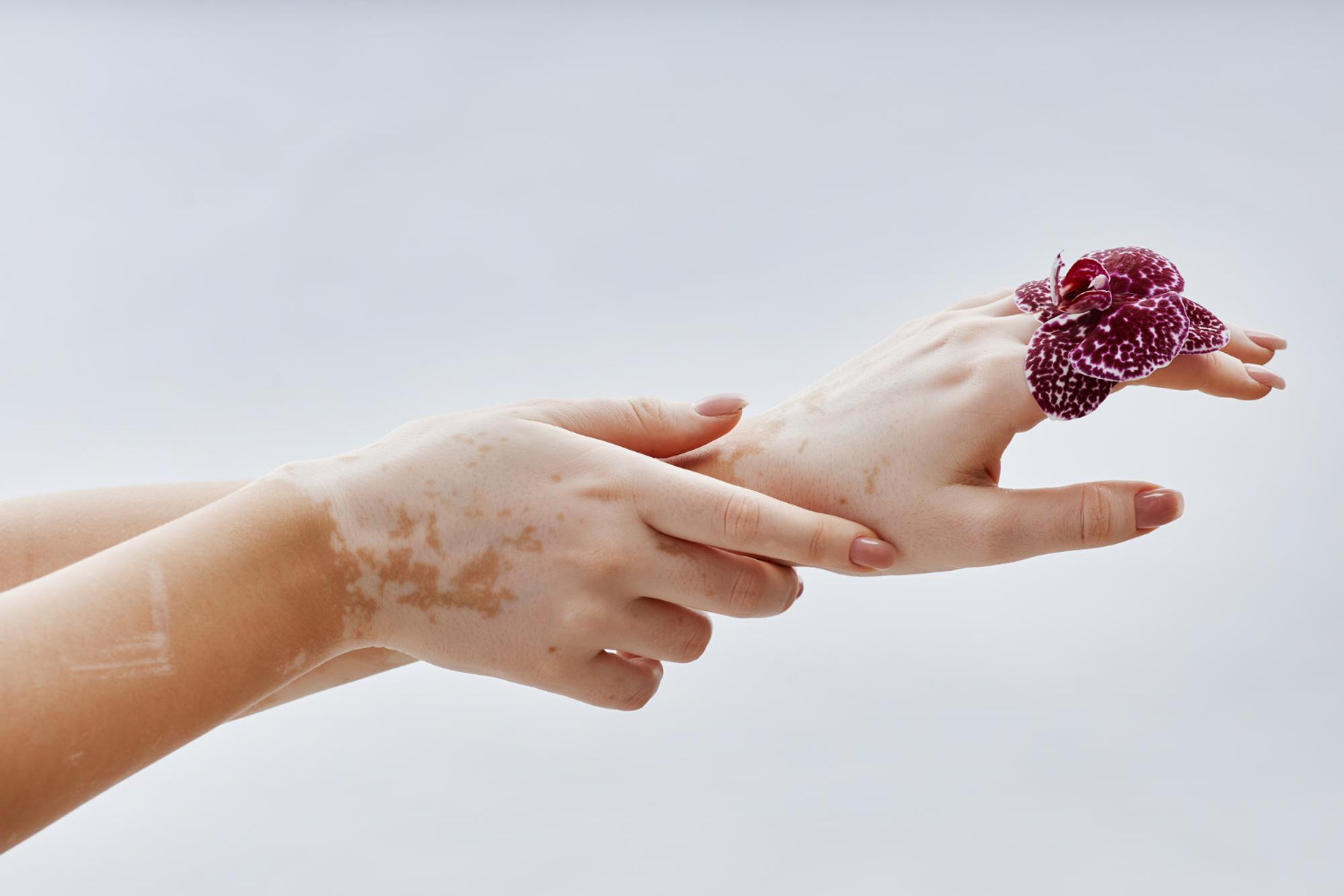 Vitiligo