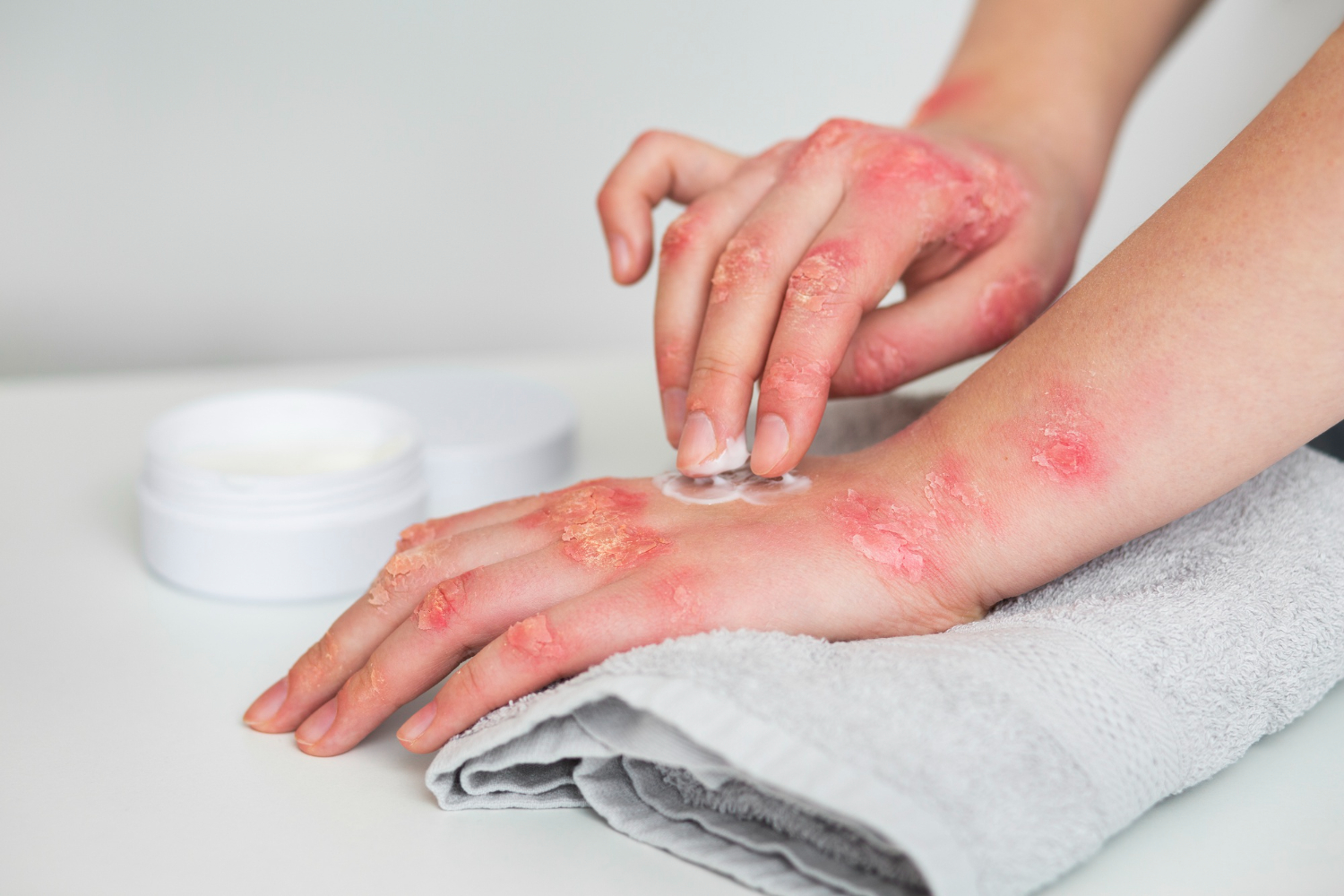 Xeroderma Pigmentosum
