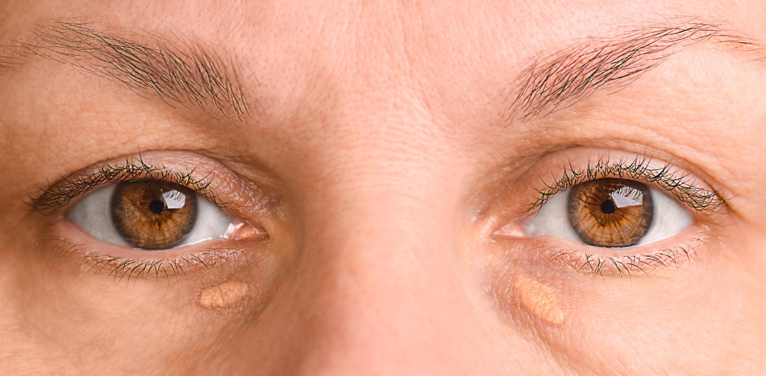 Xanthelasma