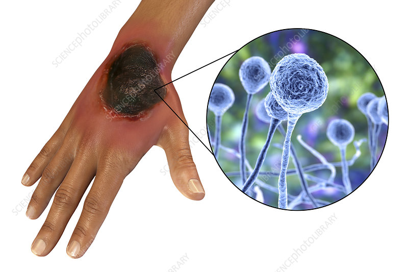 Zygomycosis (Mucormycosis)