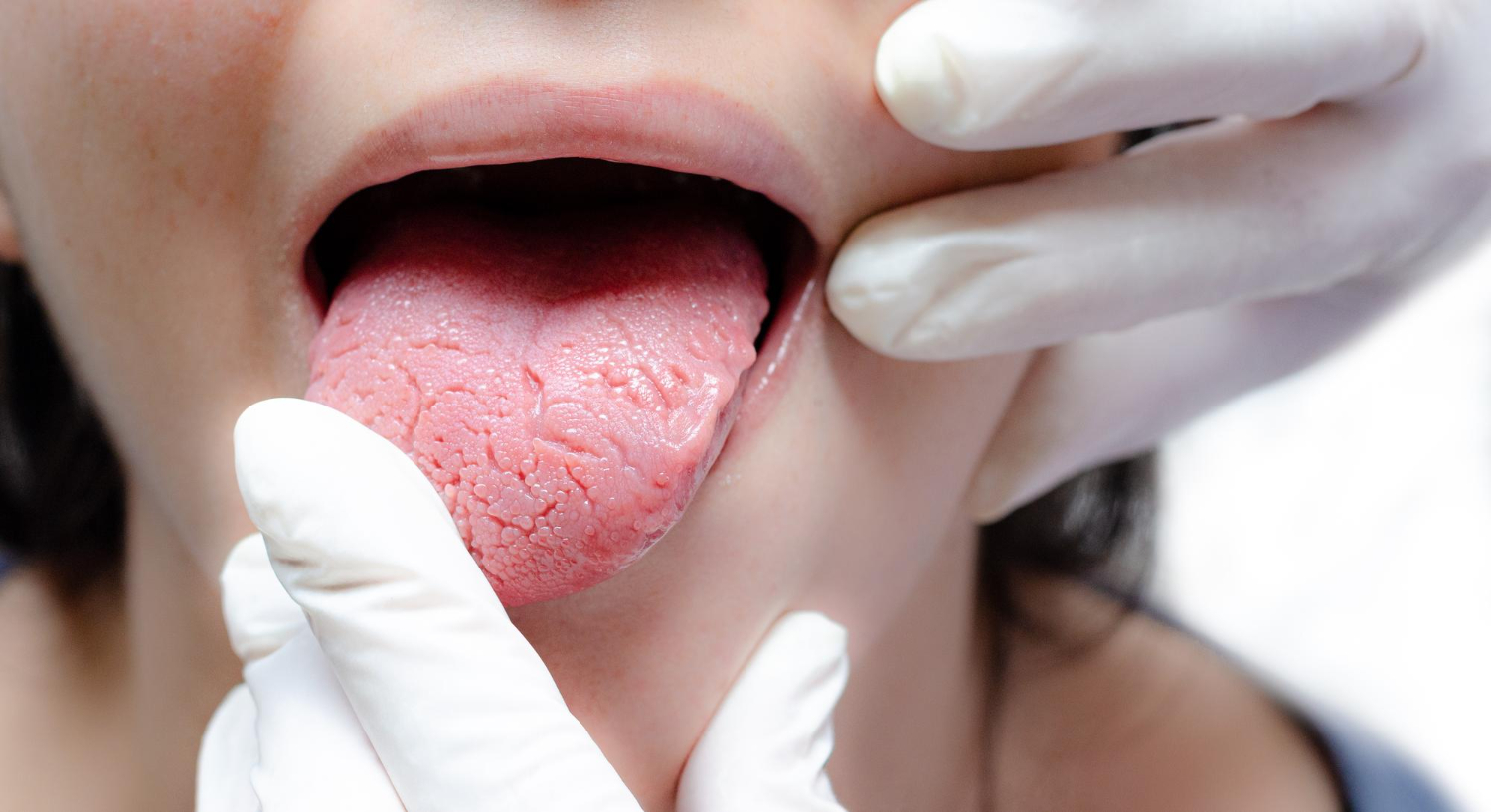 Candidiasis (Infeksi Jamur Candida)