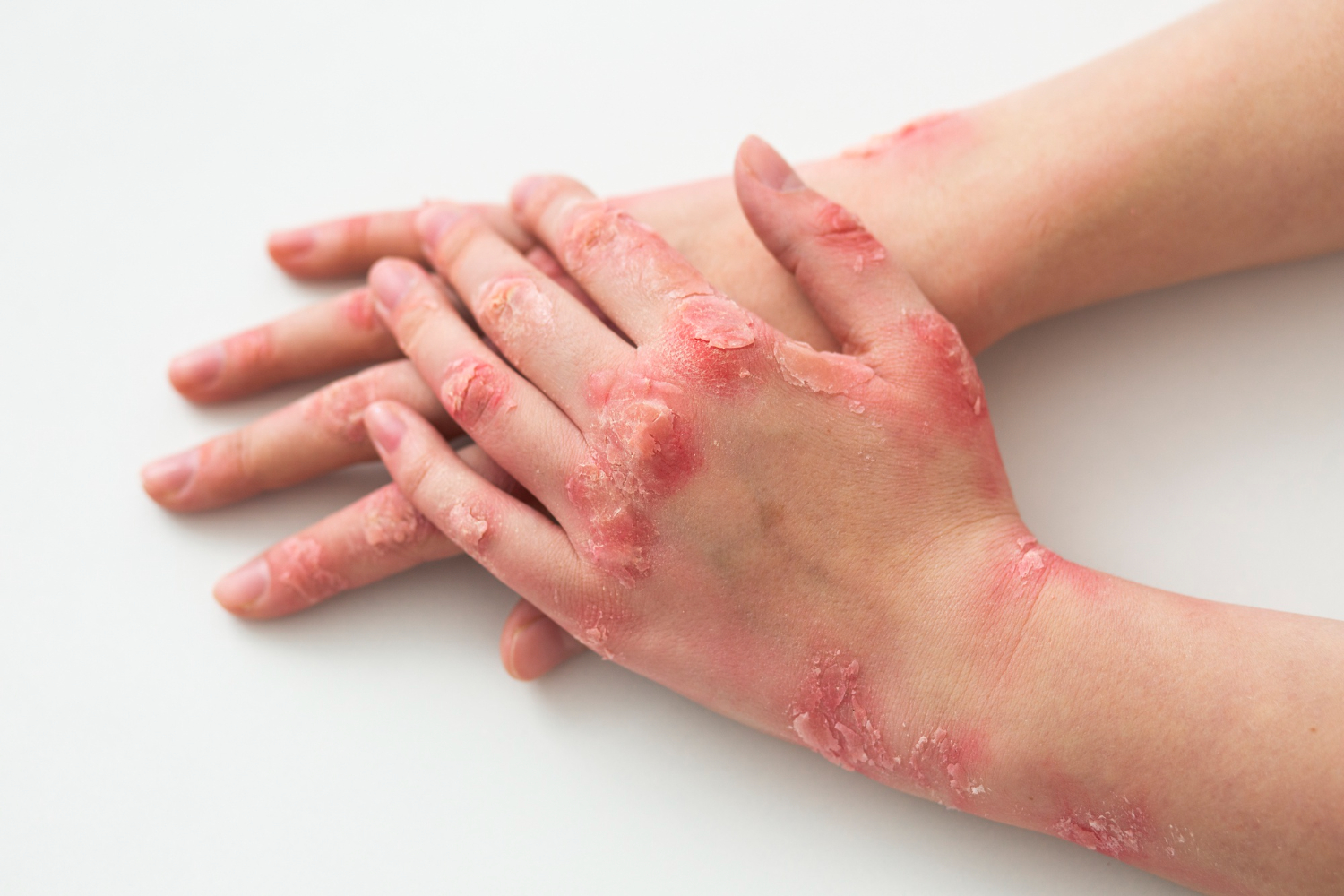 Dermatitis