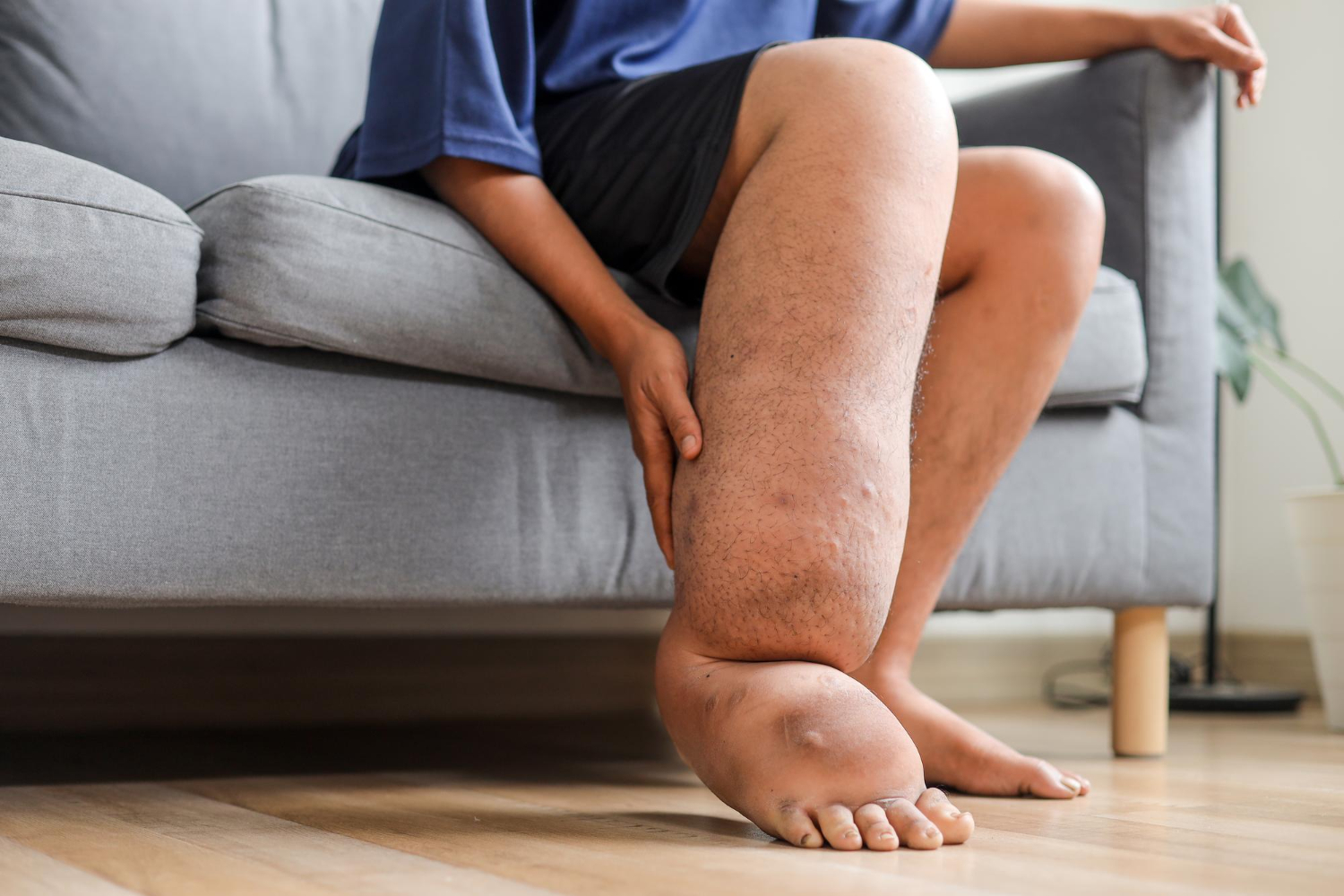 Filariasis