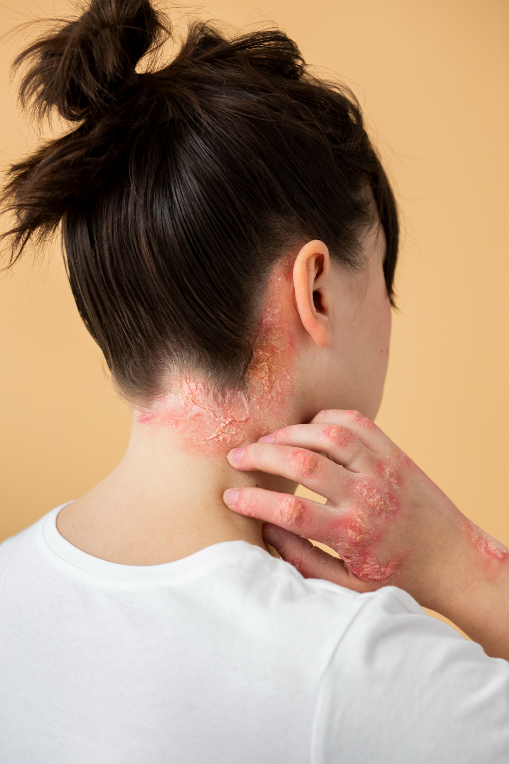 Hidradenitis Suppurativa