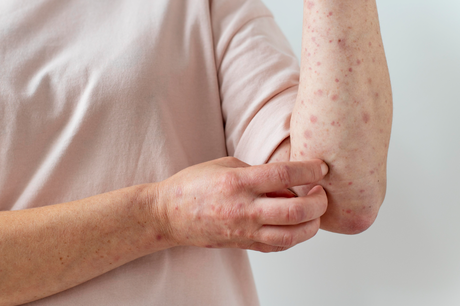 Impetigo