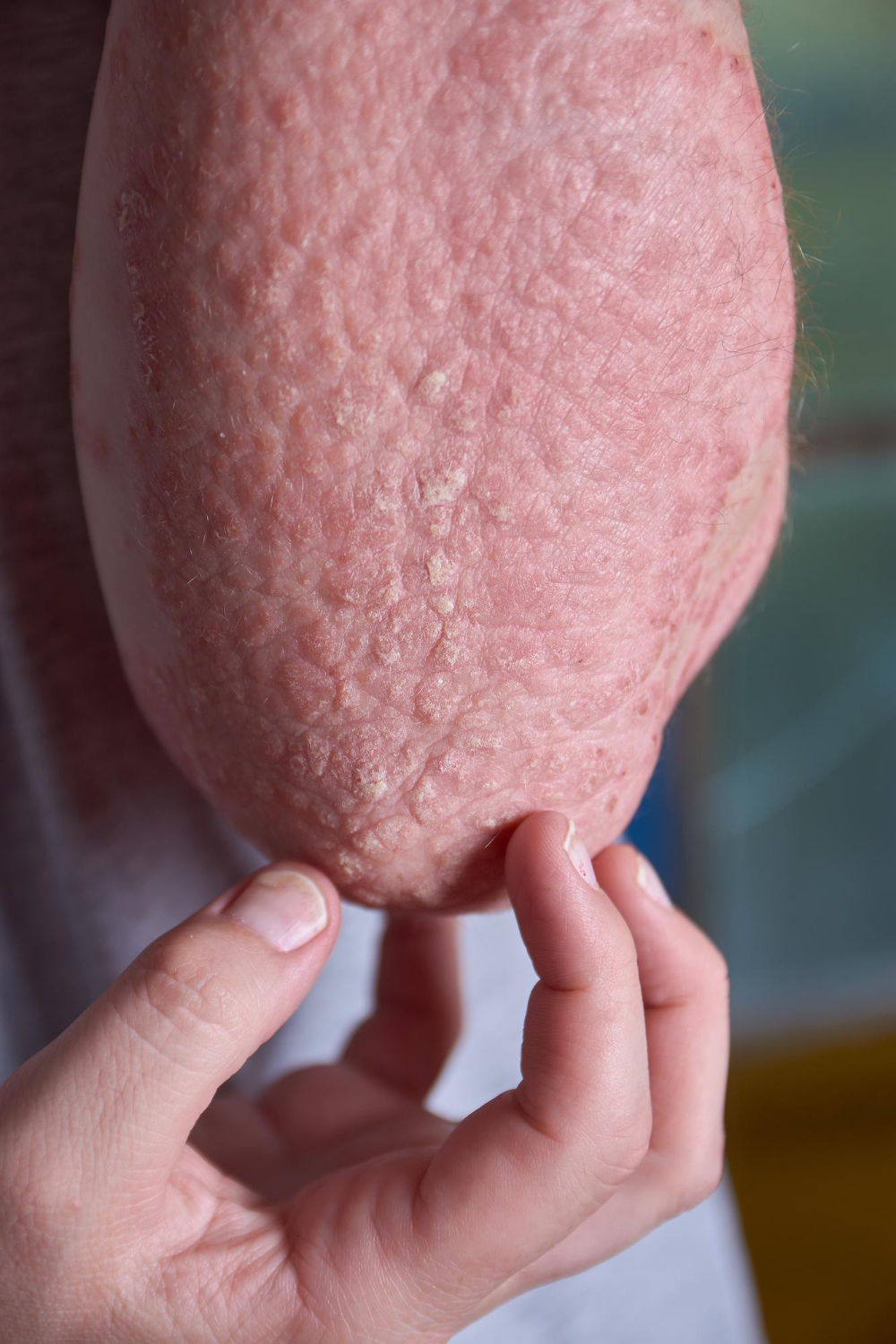 Jamur Kulit (Dermatofitosis)