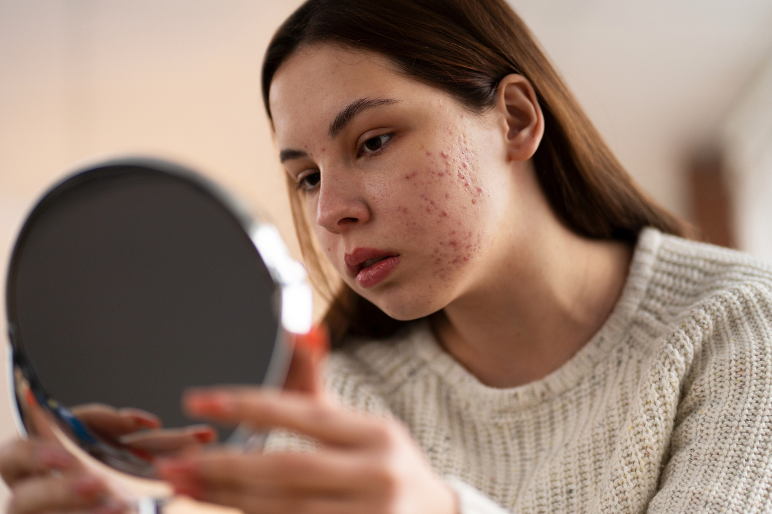 Jerawat Rosacea